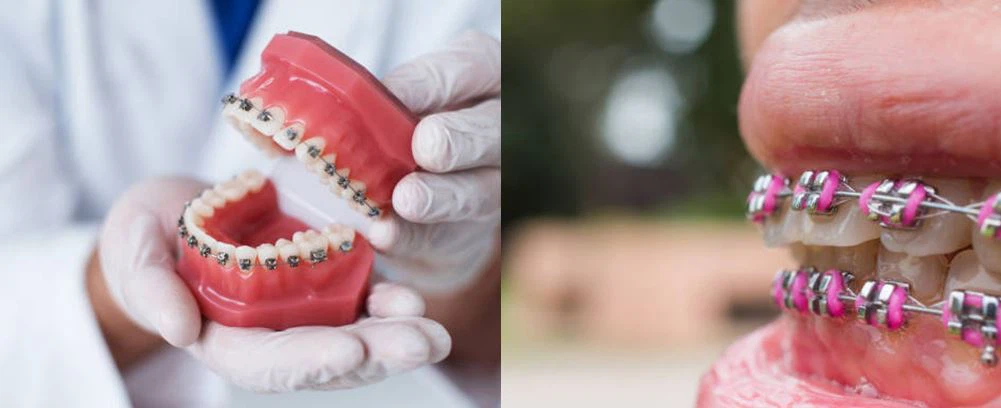 orthodontic power chain application